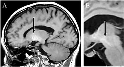 Case report: Recurring and treatment-resistant depression in acquired hepatocerebral degeneration due to a congenital portosystemic shunt